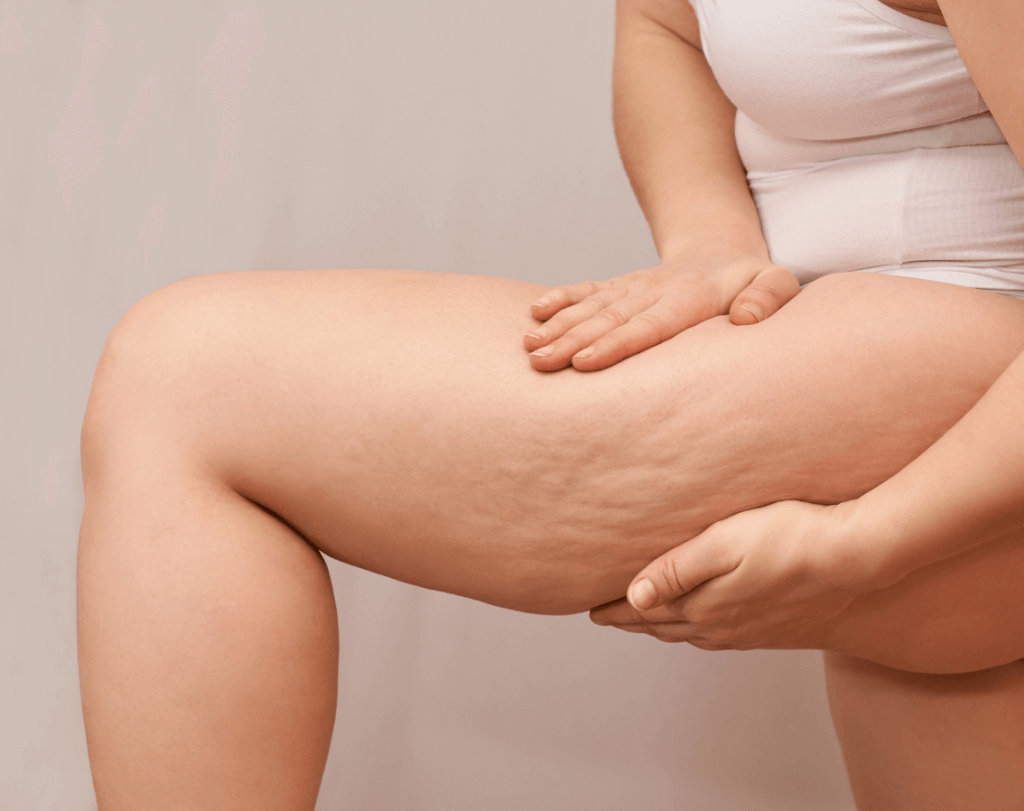 Alteraciones de la piel celulitis 2