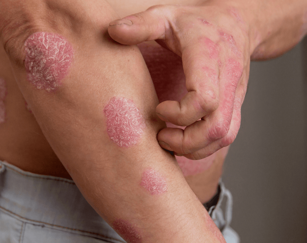 Alteraciones de la piel psoriasis