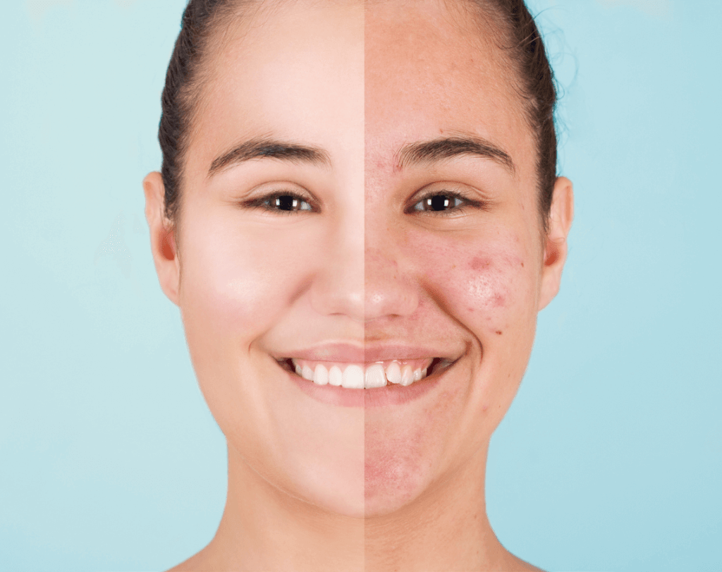 alteraciones de la piel acne 3