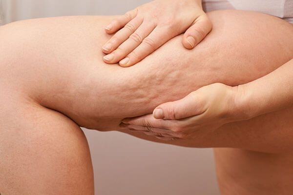 tratamiento celulitis red bosque