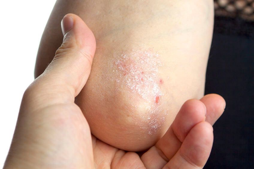 tratamiento psoriasis red bosque