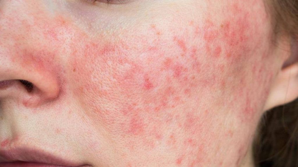 tratamiento rosacea red bosque